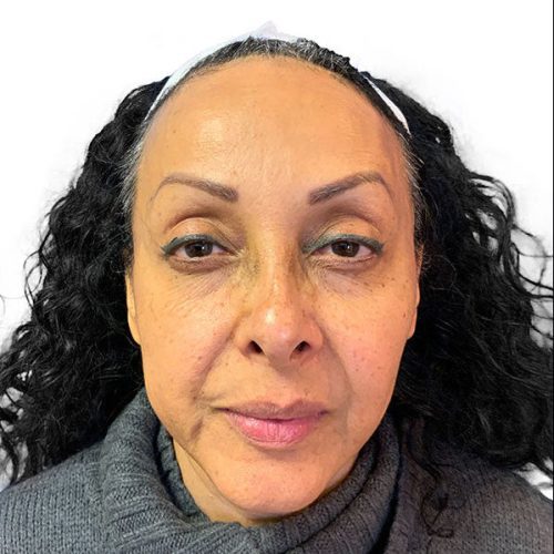 Medical-Grade Chemical Peels Before and After - Case chemicalpeels, Image 2 - Female, age 35 – 44 - Longmont, CO - Institute for Ageless Living