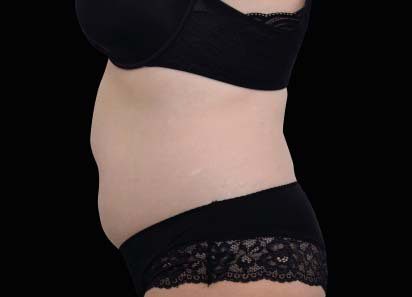 Emsculpt Neo Before and After - Case -1, Image 2 - Female, age 35 – 44 - Longmont, CO - Institute for Ageless Living