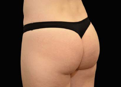 Emsculpt Neo Before and After - Case 2, Image 2 - Female, age 25 – 34 - Longmont, CO - Institute for Ageless Living