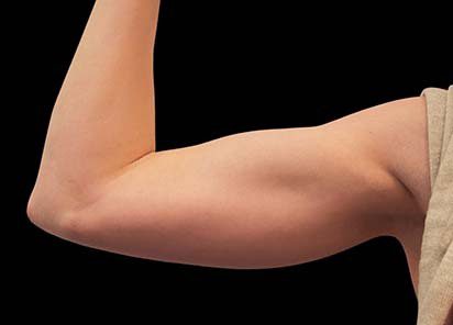 Emsculpt Neo Before and After - Case 3, Image 2 - Female, age 25 – 34 - Longmont, CO - Institute for Ageless Living