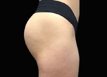 Emsculpt Neo Before & Afters | Institute for Ageless Living