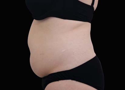 Emsculpt Neo Before and After - Case -1, Image 1 - Female, age 35 – 44 - Longmont, CO - Institute for Ageless Living