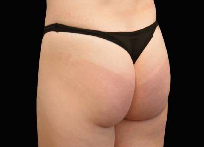 Emsculpt Neo Before and After - Case 2, Image 1 - Female, age 25 – 34 - Longmont, CO - Institute for Ageless Living
