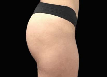 Emsculpt Neo Before & Afters | Institute for Ageless Living
