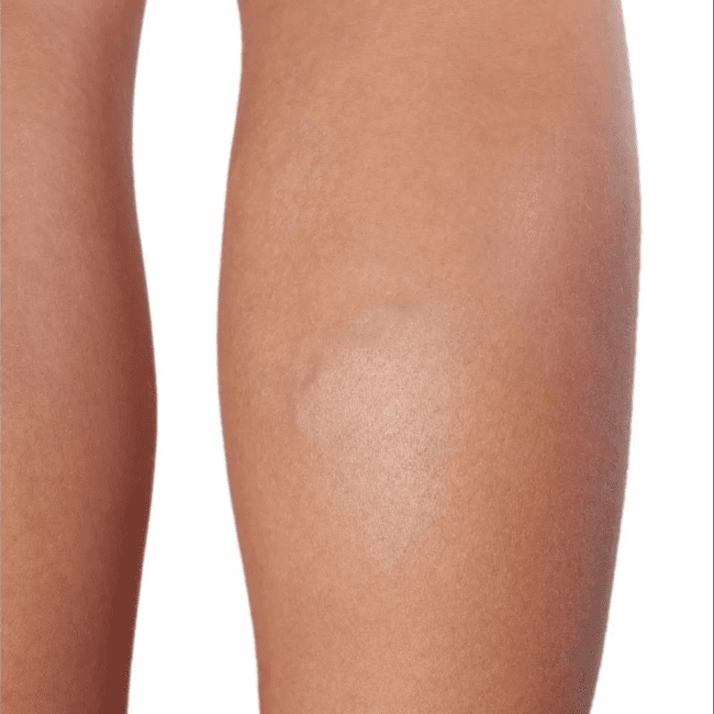Laser Vein Treatment Before & Afters | Institute for Ageless Living