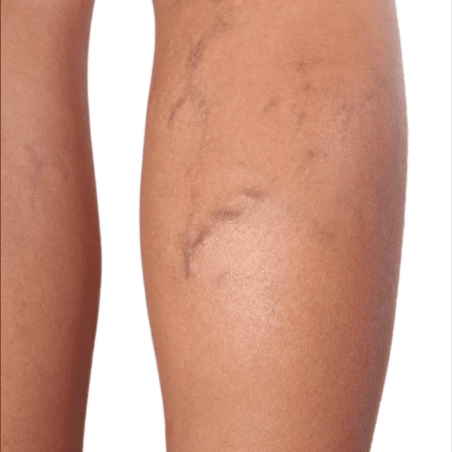 Laser Vein Treatment Before & Afters | Institute for Ageless Living