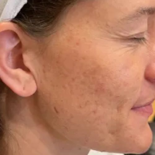 Acne and Scar Treatment Before and After - Case -1, Image 2 - Female, age 25 – 34 - Longmont, CO - Institute for Ageless Living