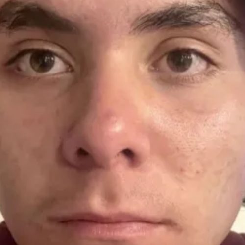 Acne and Scar Treatment Before and After - Case 2, Image 2 - Male, age 25 – 34 - Longmont, CO - Institute for Ageless Living