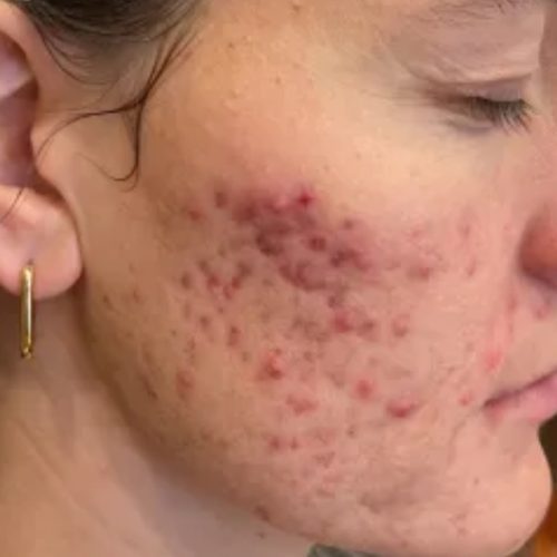 Acne and Scar Treatment Before and After - Case -1, Image 1 - Female, age 25 – 34 - Longmont, CO - Institute for Ageless Living