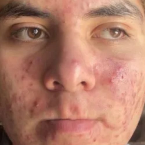Acne and Scar Treatment Before and After - Case 2, Image 1 - Male, age 25 – 34 - Longmont, CO - Institute for Ageless Living