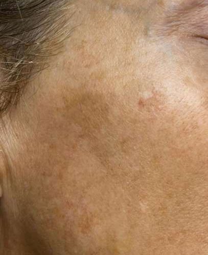 Pigment and Melasma Treatment Before and After - Case -1, Image 2 - Female, age 35 – 44 - Longmont, CO - Institute for Ageless Living