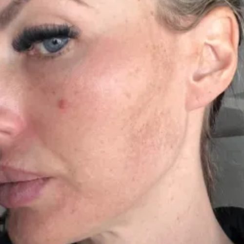 Pigment and Melasma Treatment Before and After - Case 3, Image 2 - Female, age 35 – 44 - Longmont, CO - Institute for Ageless Living