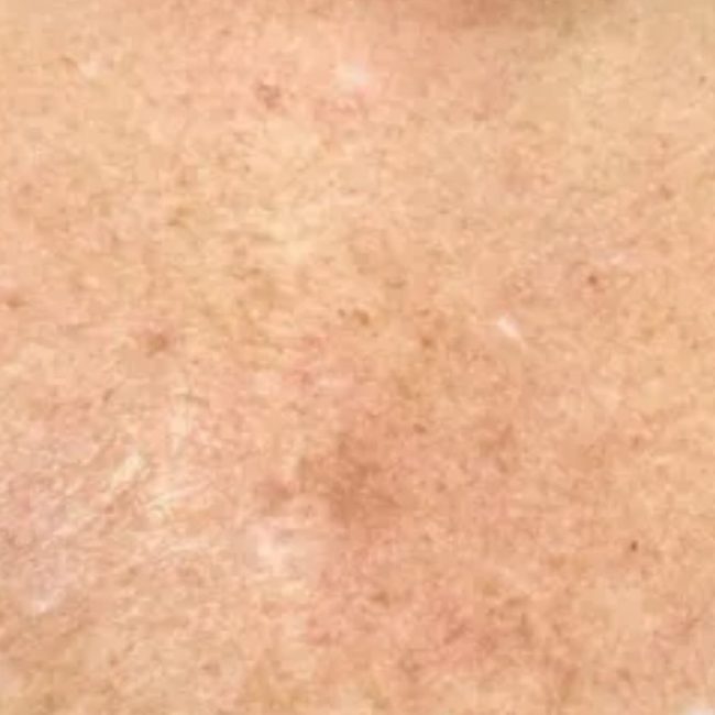 Pigment and Melasma Treatment Before & Afters | Institute for Ageless Living