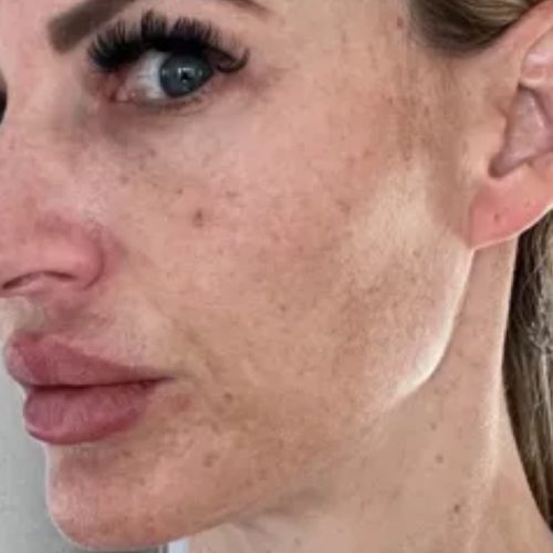 Pigment and Melasma Treatment Before and After - Case 3, Image 1 - Female, age 35 – 44 - Longmont, CO - Institute for Ageless Living