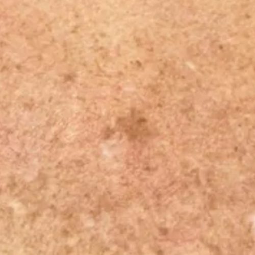 Pigment and Melasma Treatment Before and After - Case 4, Image 1 - Female, age 35 – 44 - Longmont, CO - Institute for Ageless Living