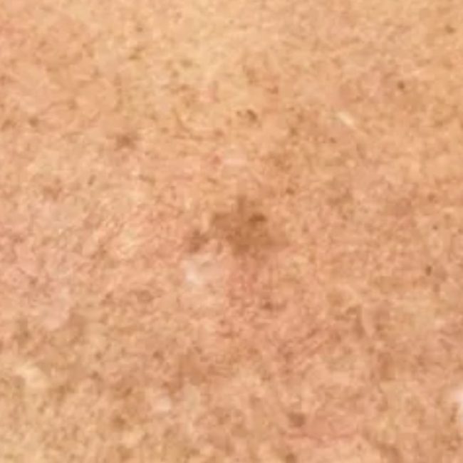 Pigment and Melasma Treatment Before & Afters | Institute for Ageless Living