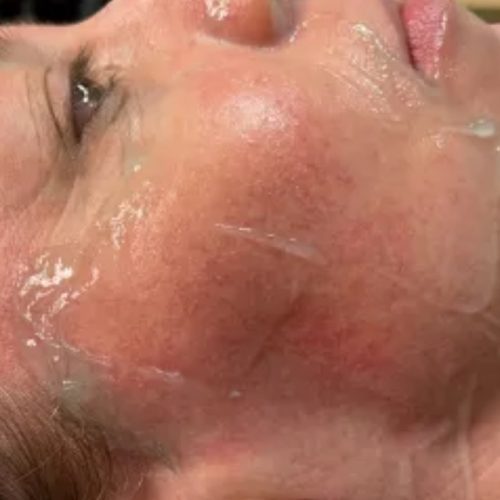 Rosacea Treatment Before and After - Case 5, Image 2 - Female, age 45 – 54 - Longmont, CO - Institute for Ageless Living