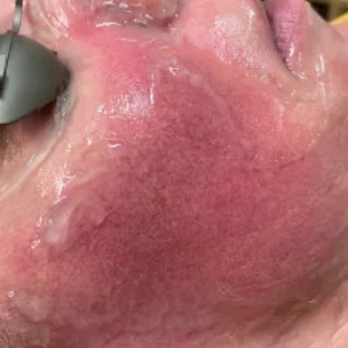Rosacea Treatment Before and After - Case 5, Image 1 - Female, age 45 – 54 - Longmont, CO - Institute for Ageless Living
