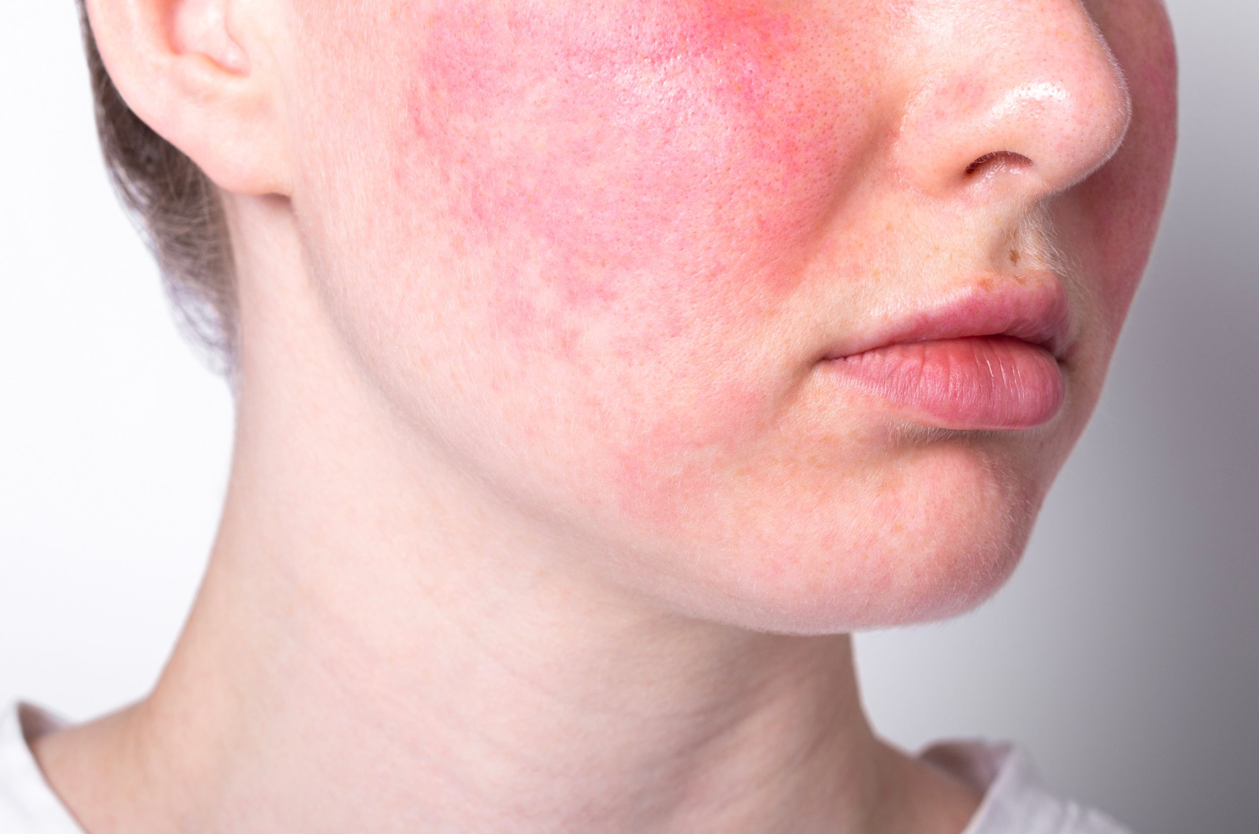 A close-up of a person's face showing red, irritated, and inflamed skin on the cheeks, possibly due to a skin condition such as rosacea or an allergic reaction—highlighting the importance of skin wellness and gentle care promoted by the Institute For Ageless Living.