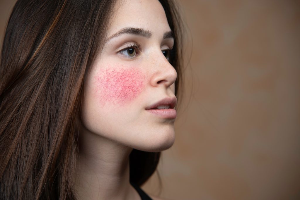 A woman with long brown hair has red, blotchy skin on her left cheek, possibly showing symptoms of a skin condition like rosacea. She is looking slightly to the side against a neutral background, highlighting the importance of wellness and skincare at any age—a focus embraced by the Institute For Ageless Living.