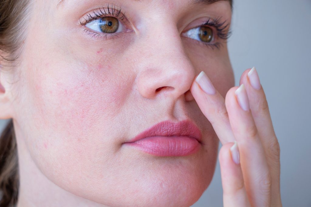 Provider at Institute for Ageless Living in Longmont Colorado performing laser treatment on a patient with rosacea redness and facial flushing