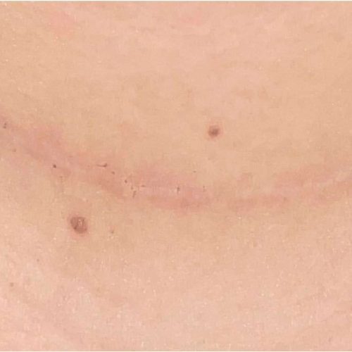 Acne and Scar Treatment Before and After - Case 3, Image 2 - Female, age 25 – 34 - Longmont, CO - Institute for Ageless Living