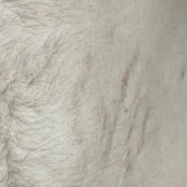 Acne and Scar Treatment Before & Afters | Institute for Ageless Living