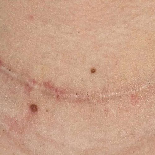 Acne and Scar Treatment Before and After - Case 3, Image 1 - Female, age 25 – 34 - Longmont, CO - Institute for Ageless Living