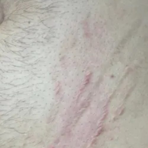 Acne and Scar Treatment Before and After - Case 4, Image 1 - Male, age 45 – 54 - Longmont, CO - Institute for Ageless Living