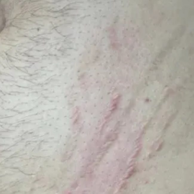 Acne and Scar Treatment Before & Afters | Institute for Ageless Living