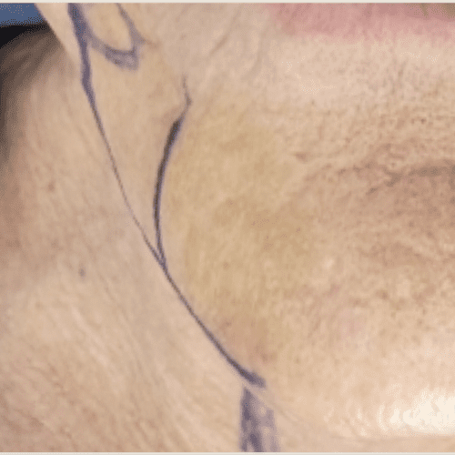Junera Before and After - Case -1, Image 2 - Female, age 55 – 64 - Longmont, CO - Institute for Ageless Living