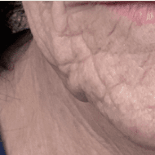 Junera Before and After - Case -1, Image 1 - Female, age 55 – 64 - Longmont, CO - Institute for Ageless Living