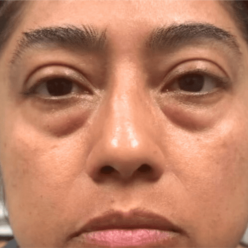Junera Before and After - Case 2, Image 1 - Female, age 35 – 44 - Longmont, CO - Institute for Ageless Living