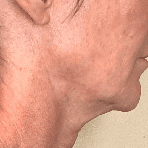 Junera Before and After - Case 3, Image 1 - Female, age 45 – 54 - Longmont, CO - Institute for Ageless Living