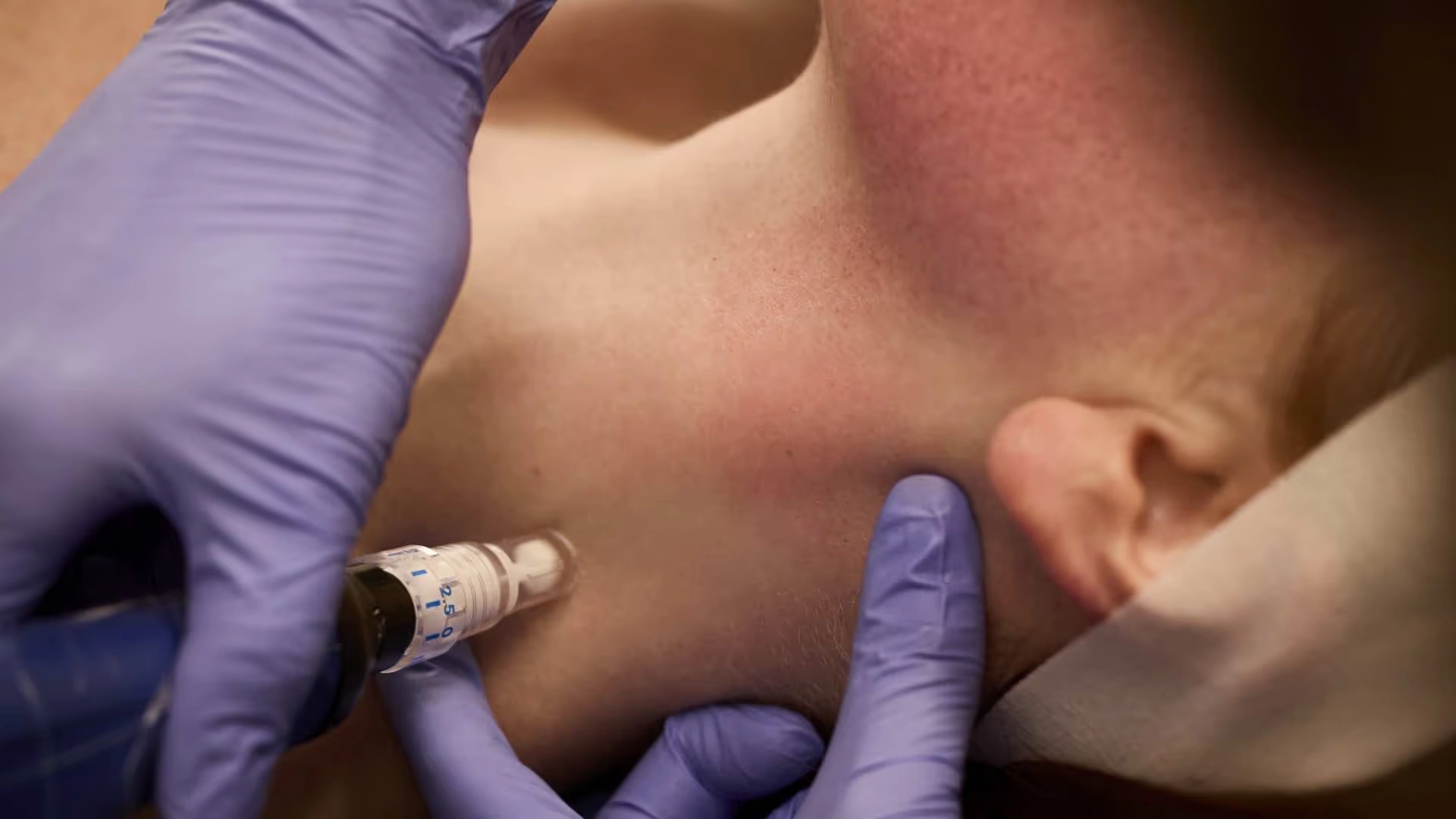 A close-up of gloved hands performing a cosmetic procedure on a person's jawline using a handheld device, with the person lying down and their head turned to the side—an advanced treatment at the Institute For Ageless Living, dedicated to promoting wellness and anti-aging solutions.